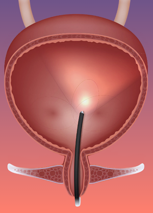 Cystoscopy proc