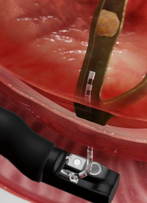 ERCP proc