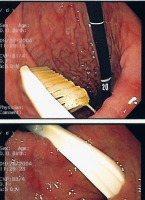 Foreign Body removal proc
