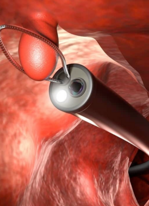 Polypectomy proc