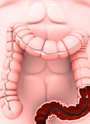 Sigmoidoscopy proc