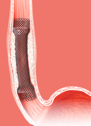 Stenting proc