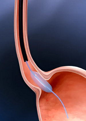 Stricture Dilatation proc