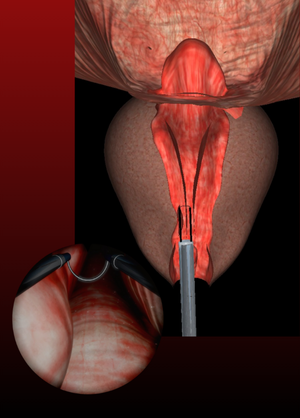 TURP proc