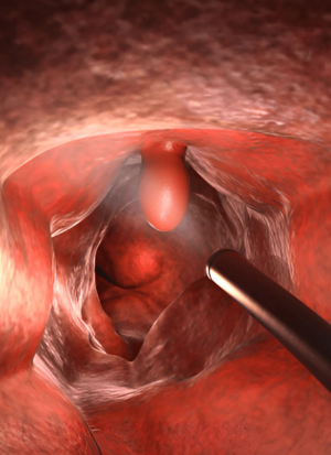 colonoscopy proc